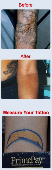 San Diego Tattoo Removal Treatment | SD Body Contouring