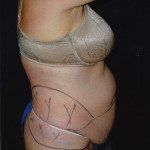 Tummy Tuck 35