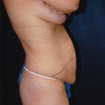 Tummy Tuck 34