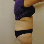 Tummy Tuck