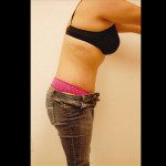 Tummy Tuck