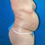 Tummy Tuck 11