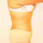 Tummy Tuck