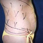 Tummy Tuck 7