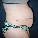 Tummy Tuck 6