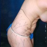 Tummy Tuck 4