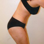 Tummy Tuck