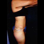 Tummy Tuck