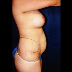 Tummy Tuck 3