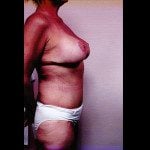 Tummy Tuck