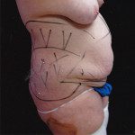 Tummy Tuck 16