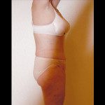 Tummy Tuck