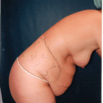 Tummy Tuck 19