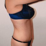 Tummy Tuck