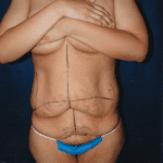 Tummy Tuck 25