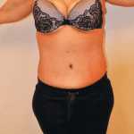 Tummy Tuck