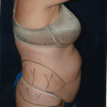 Tummy Tuck 20