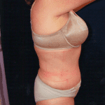 Tummy Tuck