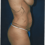 Tummy Tuck 21