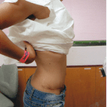 Tummy Tuck