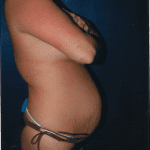 Tummy Tuck 22