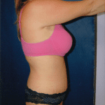 Tummy Tuck