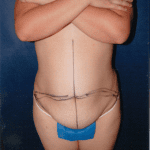 Tummy Tuck 23