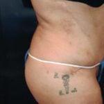 Tummy Tuck