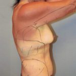 tummy tuck12-6