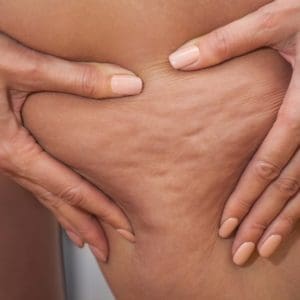 woman treated for cellulite with cellfina at san diego body contouring