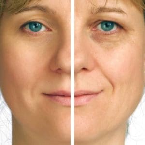 Full Facelift vs Mini Facelift at san diego body contouring