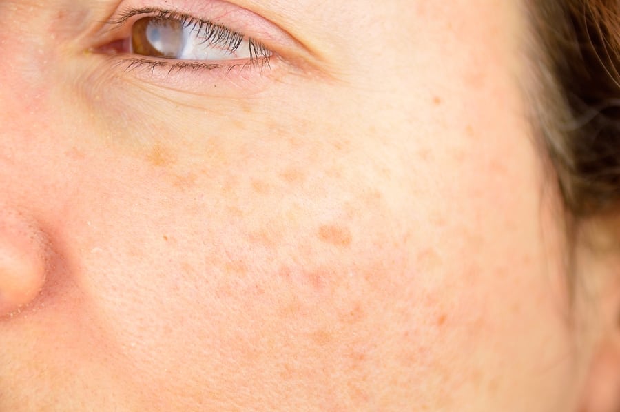 Patient at San Diego Body Contouring for IPL Photofacial treatment