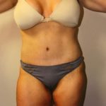 Tummy Tuck