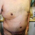 Tummy Tuck