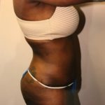 Tummy Tuck