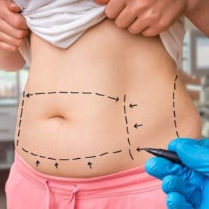 SculpSure (Non-surgical) Vs Liposuction (Surgical)