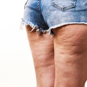 Want to Get Rid of Your Cellulite? Methods That Actually Work