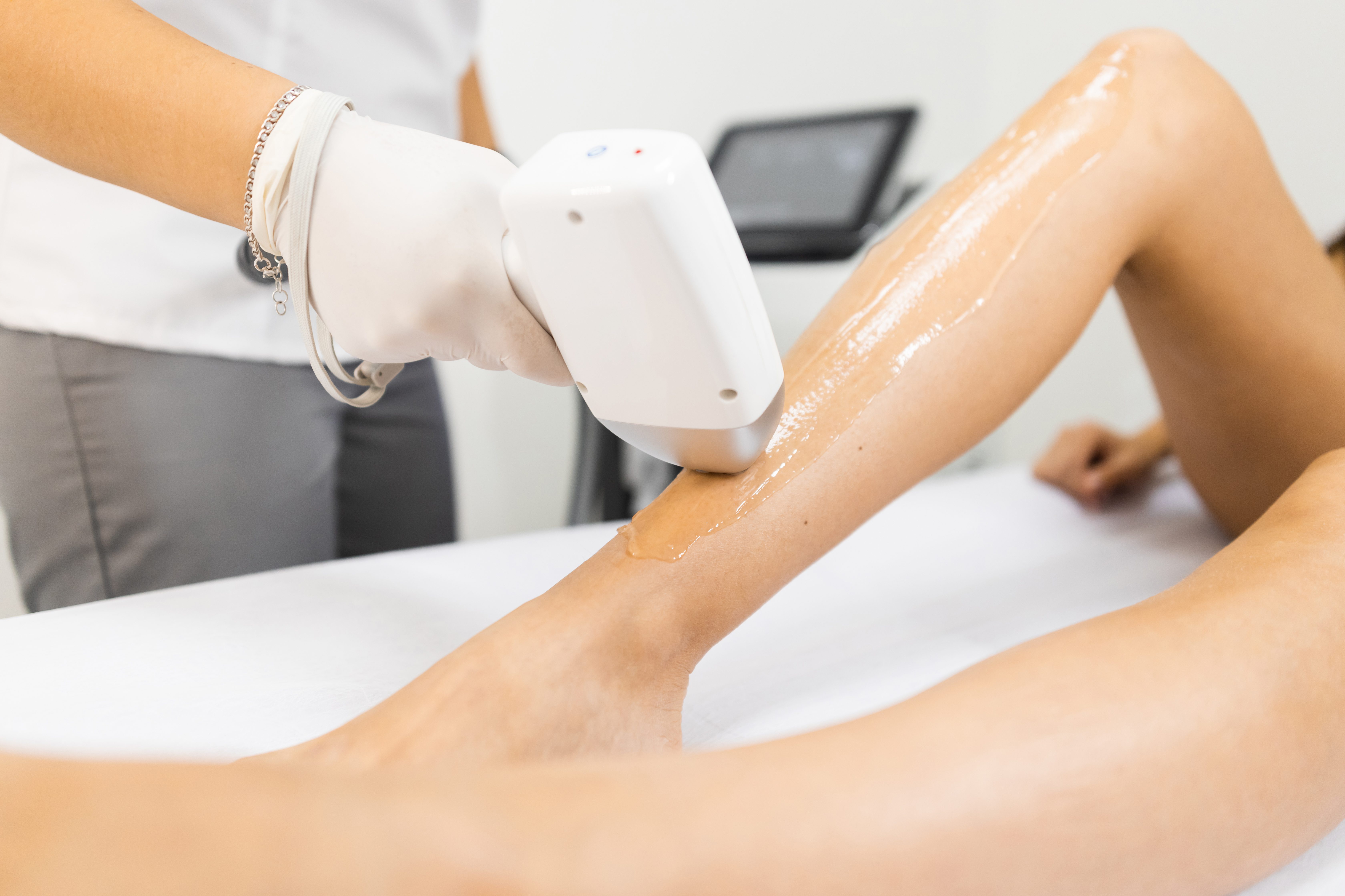 Laser Hair Removal San Diego: The Ultimate Guide to Smooth, Hair-Free Skin