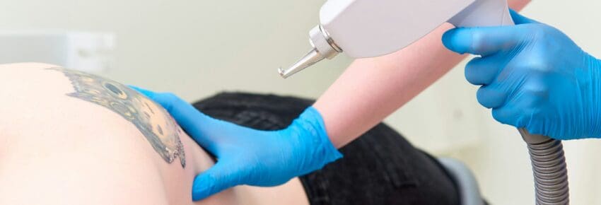 Tattoo removal in the clinic