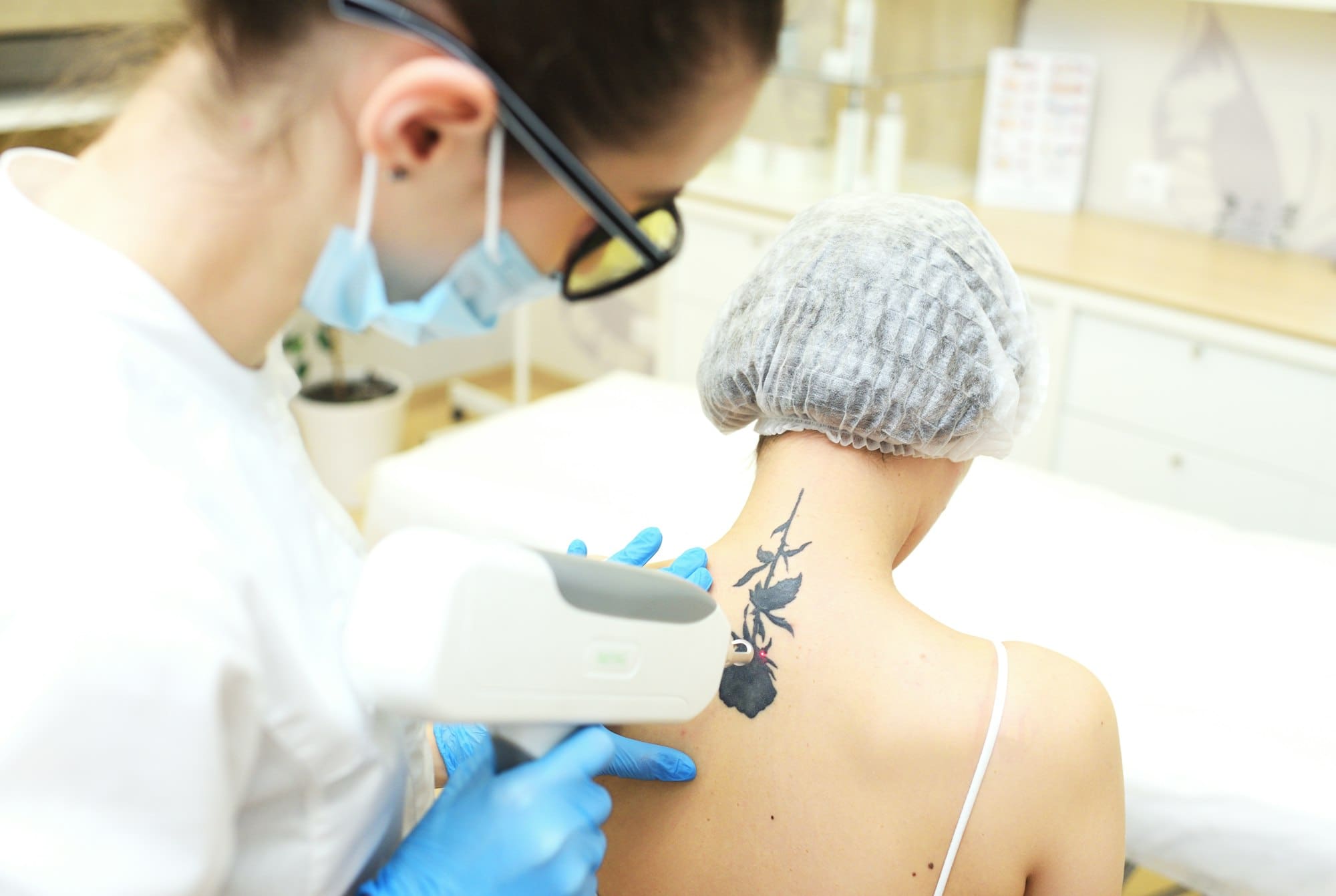 5 Things You Need to Know Before Tattoo Removal in San Diego