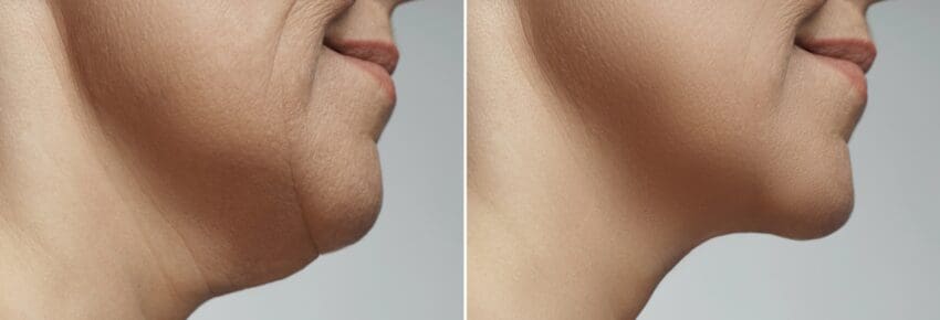 San Diego Body Contouring | Plastic Surgery
