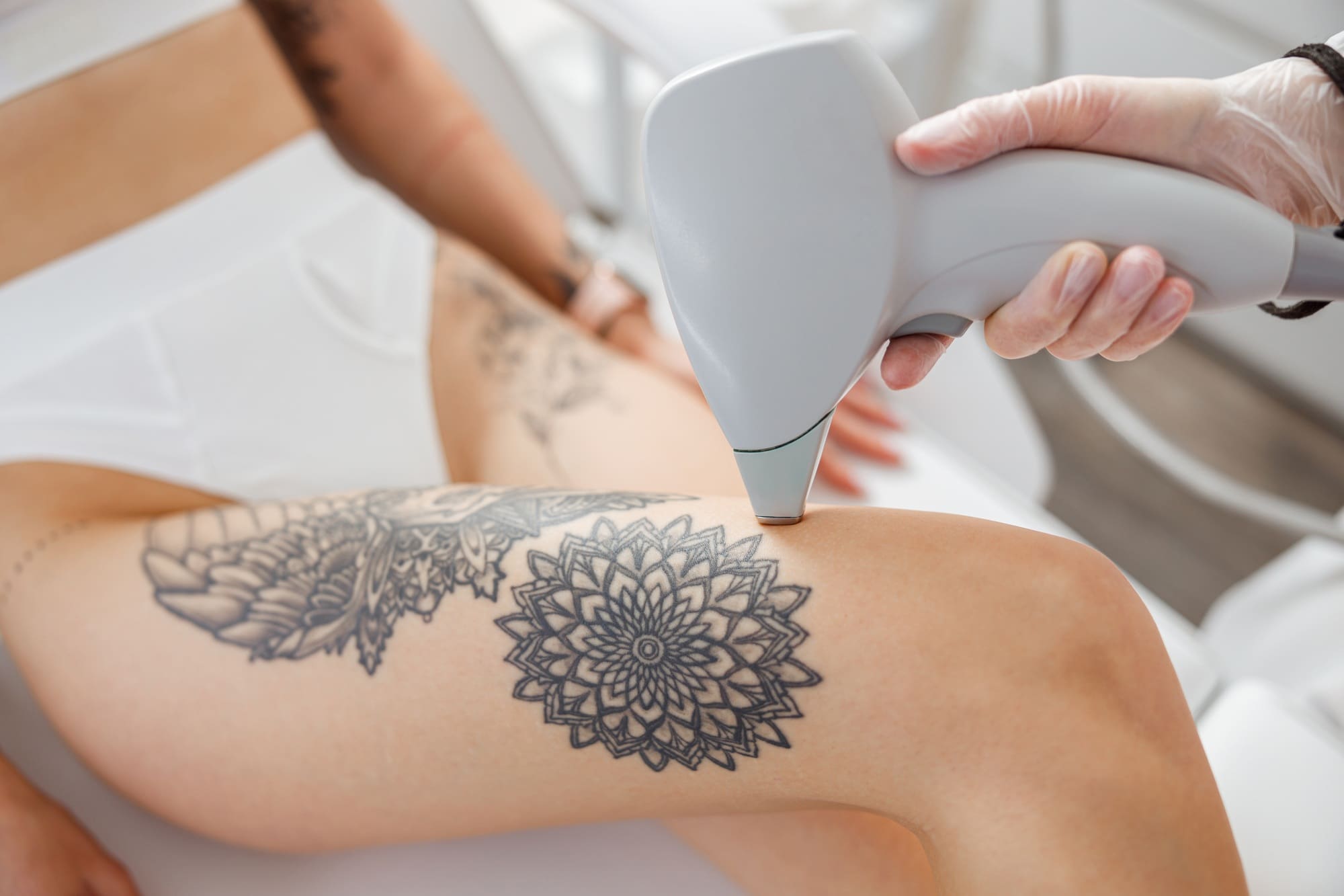 Laser Tattoo Removal San Diego: Trends in Cosmetic Surgery