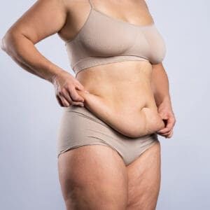 Tummy tuck, flabby skin on a fat belly, plastic surgery concept