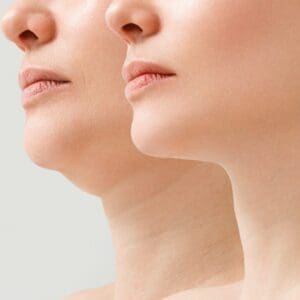 A close portrait of an aged woman before and after the facelift procedure. The result of facial rejuvenation and wrinkle smoothing in a cosmetology clinic.