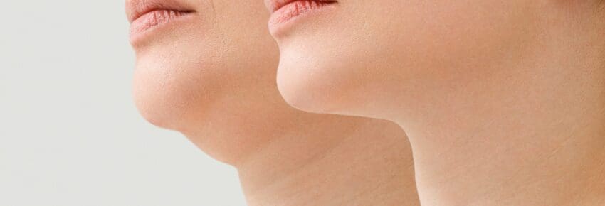A close portrait of an aged woman before and after the facelift procedure. The result of facial rejuvenation and wrinkle smoothing in a cosmetology clinic.