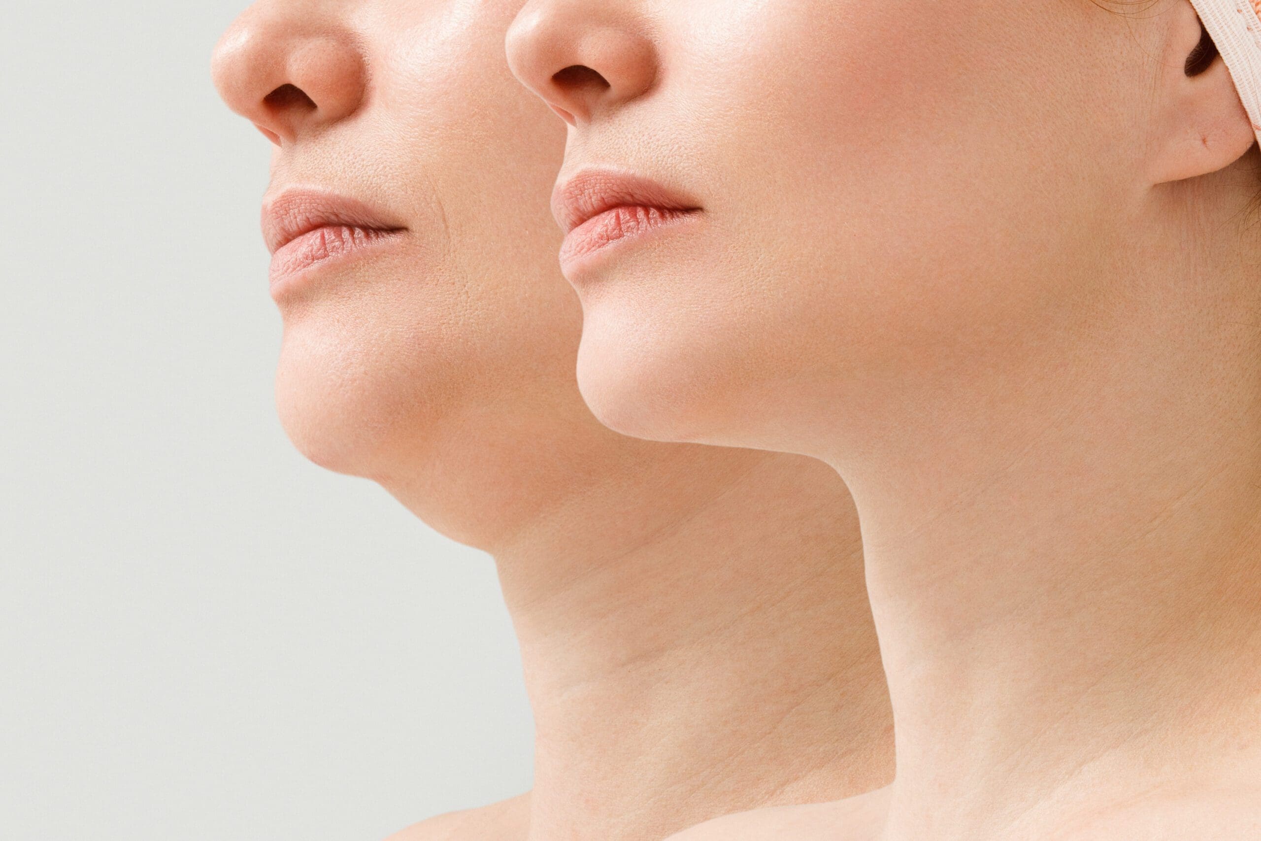 A close portrait of an aged woman before and after the facelift procedure. The result of facial rejuvenation and wrinkle smoothing in a cosmetology clinic.