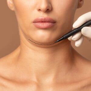Double chin removal plastic surgery operation concept. Doctor surgeon hands drawing the cut line of female double chin, closeup, cropped