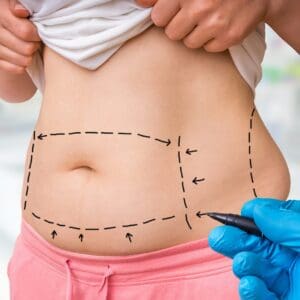 Plastic surgery doctor draw lines with marker on patient belly