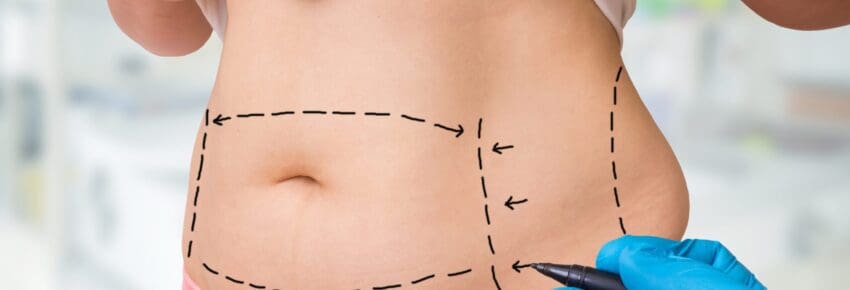 Plastic surgery doctor draw lines with marker on patient belly