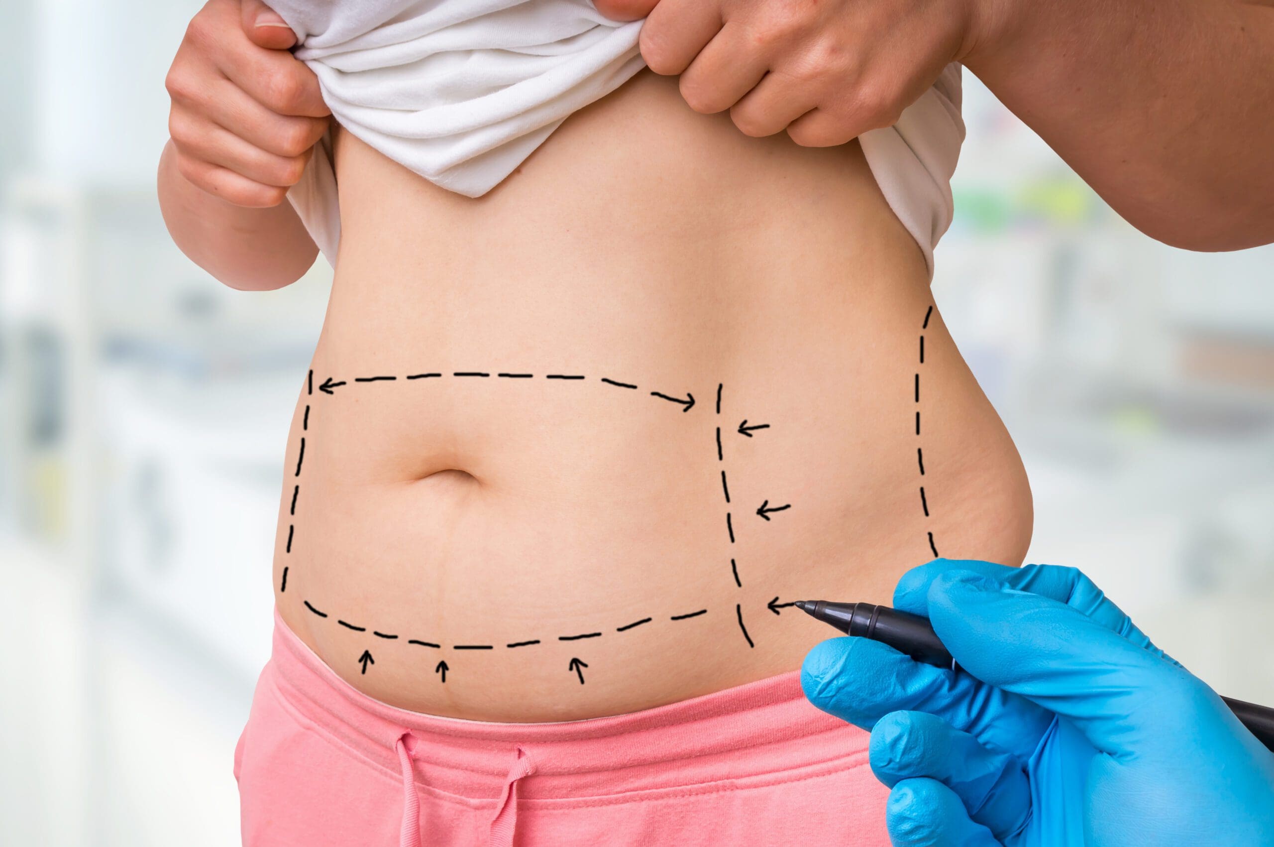 Plastic surgery doctor draw lines with marker on patient belly